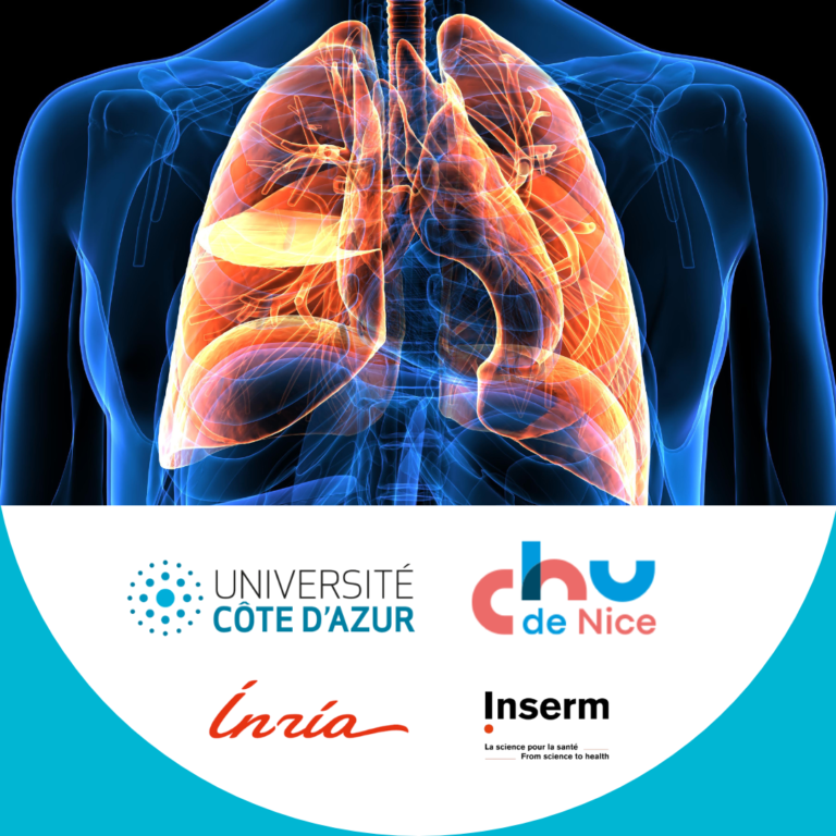 Un nouvel IHU spécialisé dans les maladies pulmonaires sera inauguré à Nice très bientôt