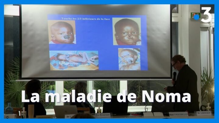 Noma : l’association Sourire un jour redonne de l’espoir aux enfants affectés
