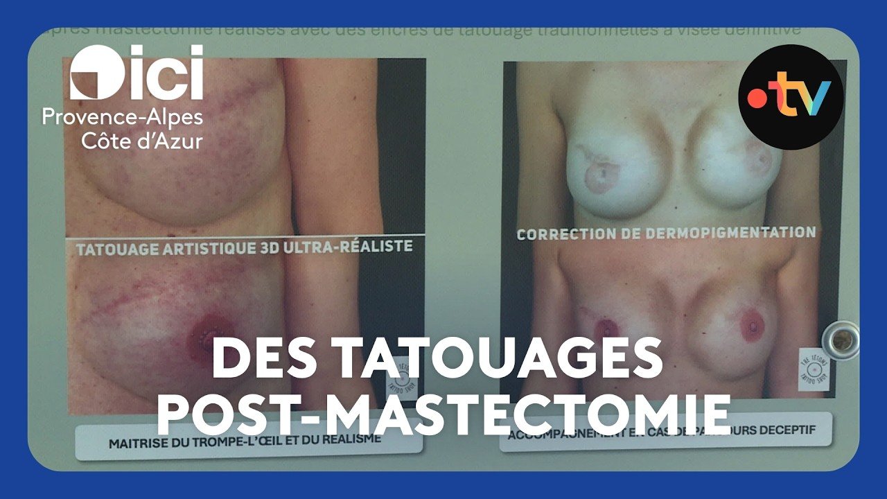 Ablation du sein : une technique de tatouage innovante pour réparer les poitrines et les tétons